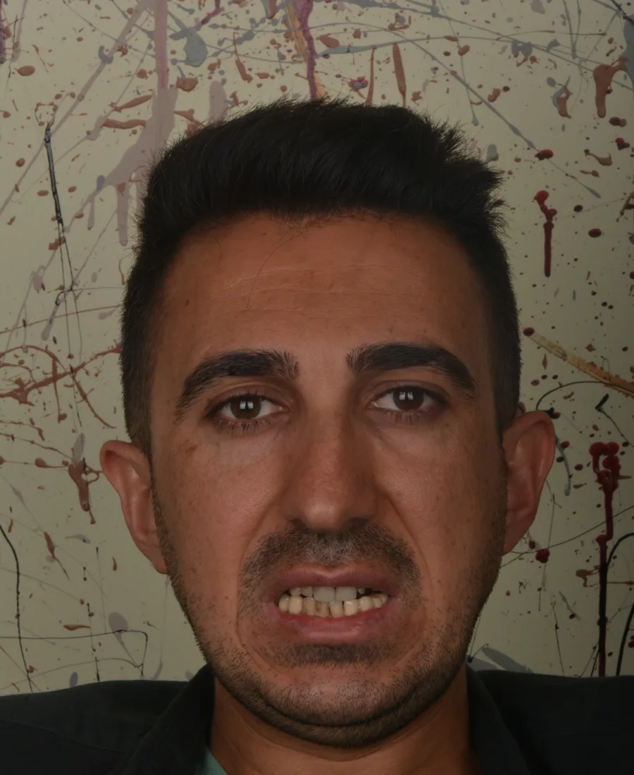 Gülüş Tasarımı — Öncesi