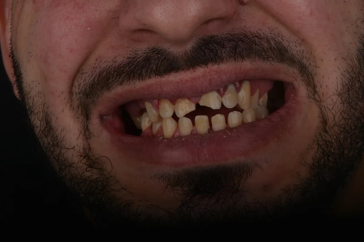 Zirkonyum — Öncesi