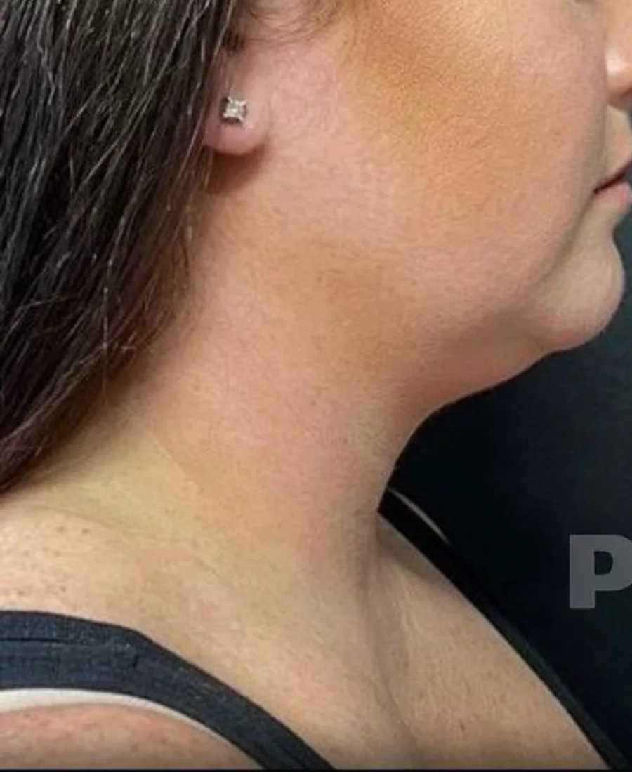 Gıdı Liposuction — Öncesi