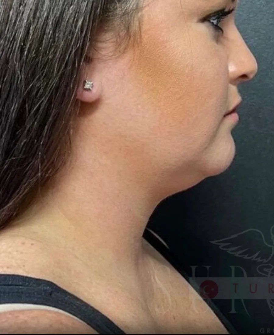 Gıdı Liposuction — Öncesi