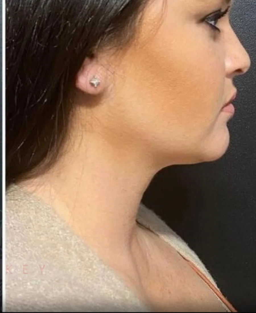 Gıdı Liposuction — Sonrası