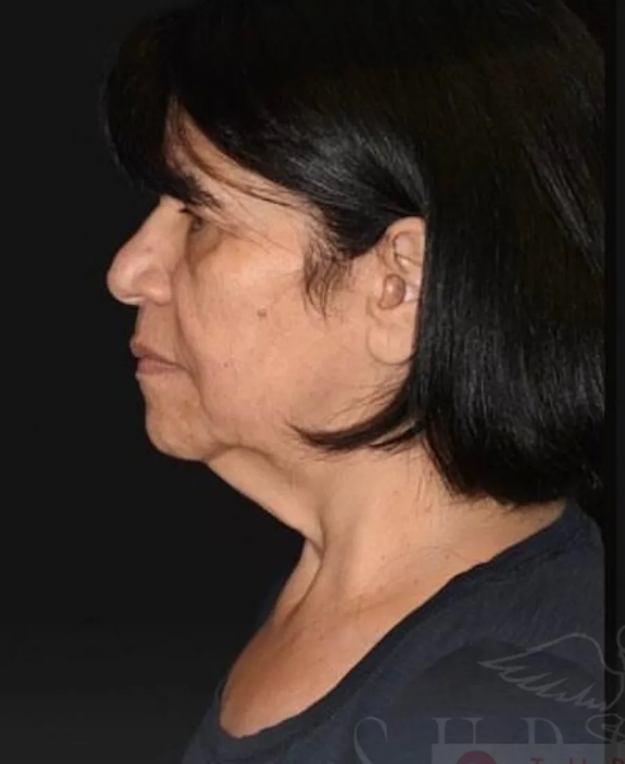 Gıdı Liposuction — Öncesi