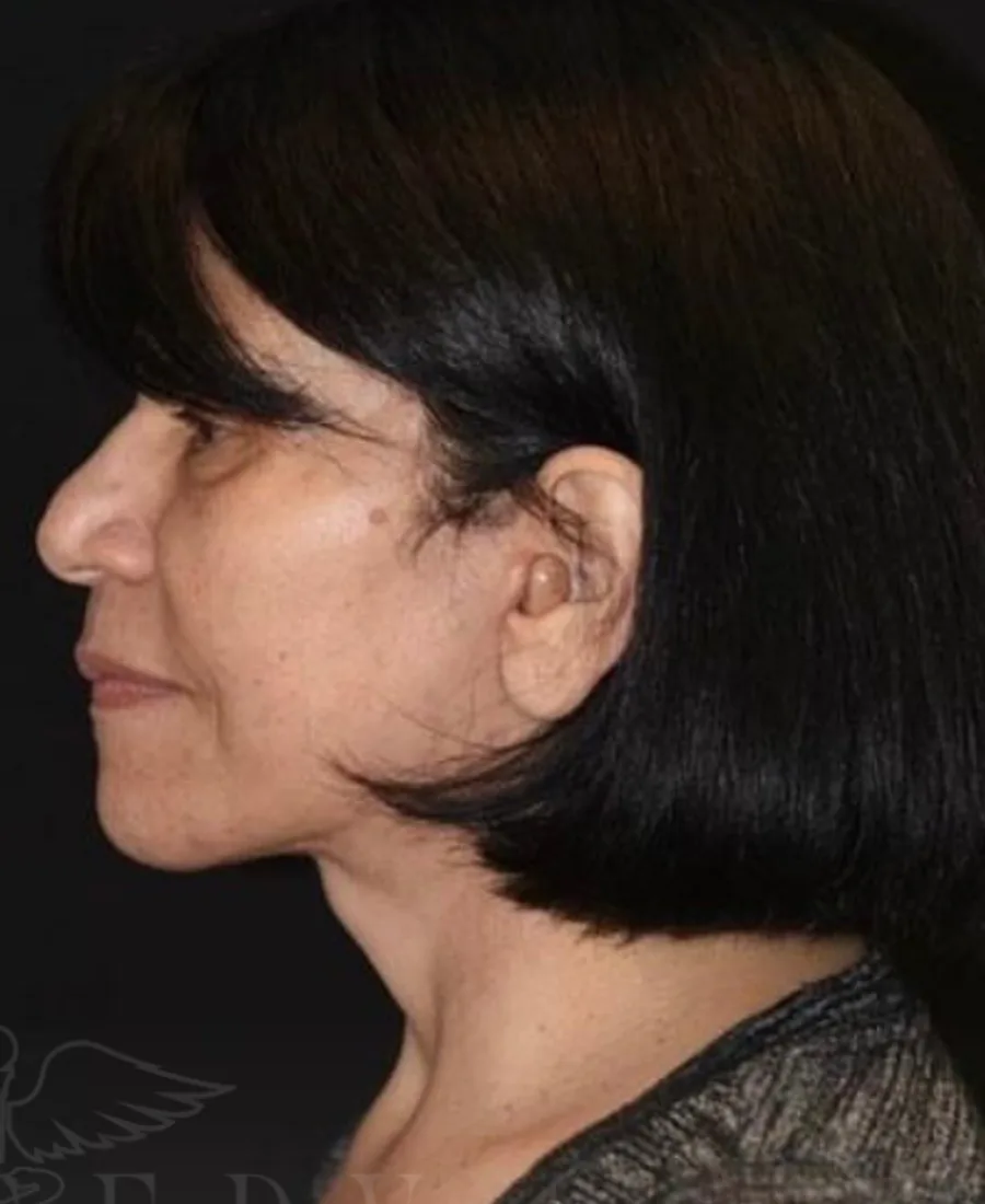 Gıdı Liposuction — Sonrası