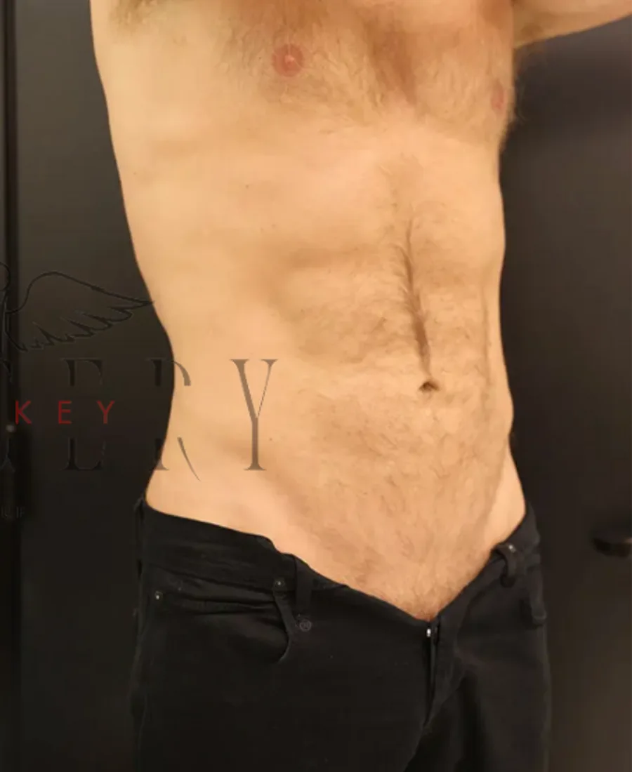 Liposuction — Sonrası