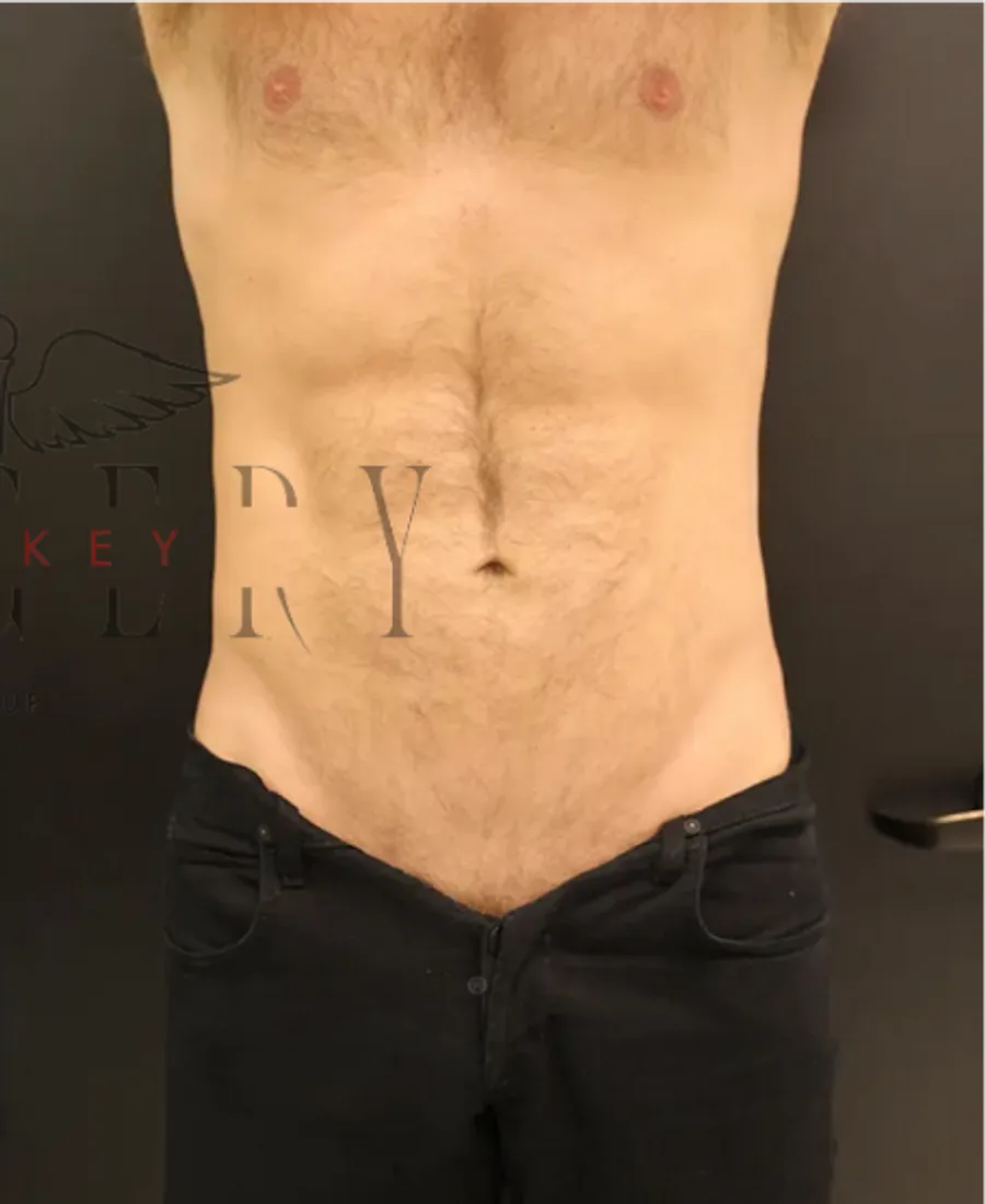 Liposuction — Sonrası