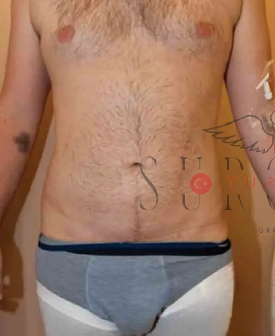 Liposuction — Öncesi