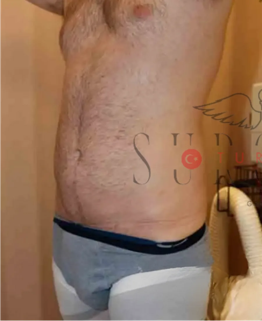 Liposuction — Öncesi