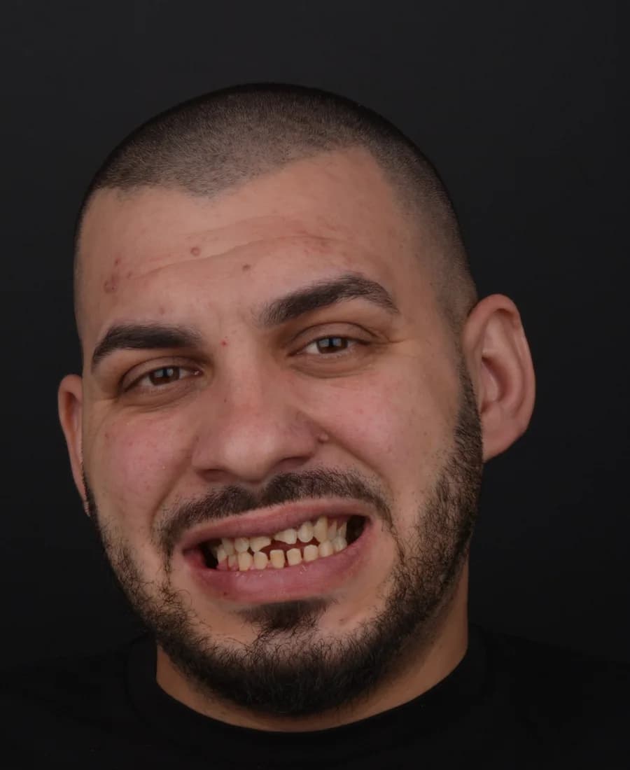 Zirkonyum — Öncesi